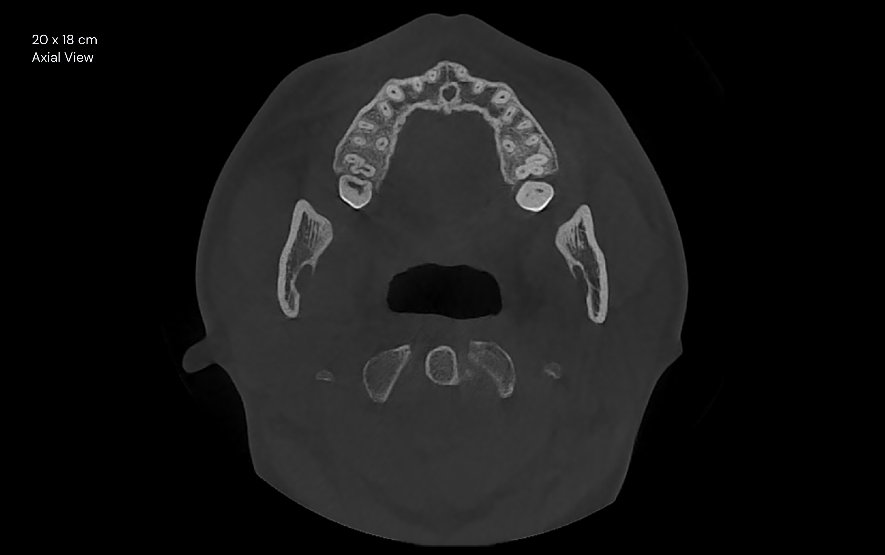 20 x 18 cm Axial View